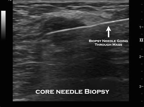Guidelines For Breast Biopsy at Crystal Molden blog
