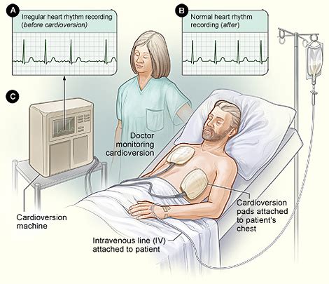 Image result for Cardioversion Procedure Note Template