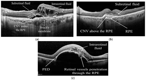 Classification of Retinal Diseases in Optical Coherence Tomography ...