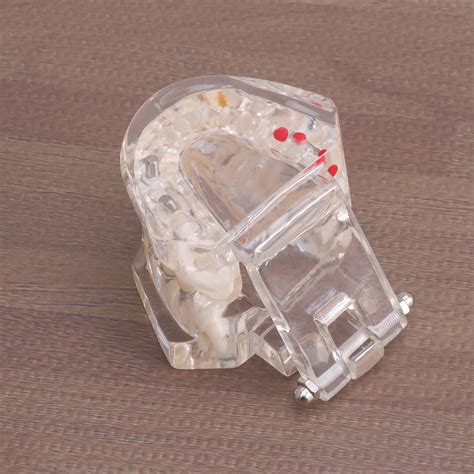 Buy BESTONZON Detachable Oral Model Removable Dental Implant Disease ...