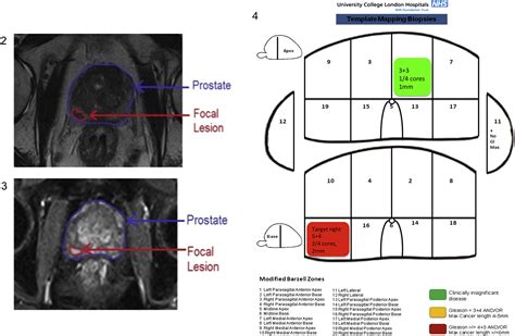 Cpt Code For Transperineal Prostate Biopsy