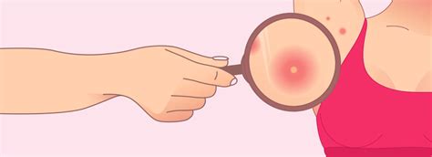 Exploding Armpit Zits 的图像结果