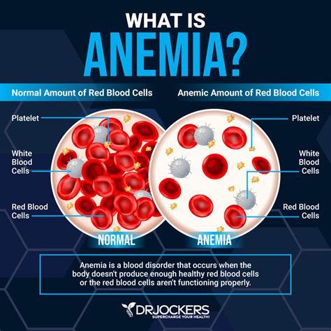 Iron Deficiency Anaemia Differential Diagnosis