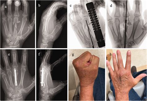 Metacarpal fractures - Alex G. Lambi, Robert J. Rowland, Nicholas W. Brady, Diego E. Rodriguez ...