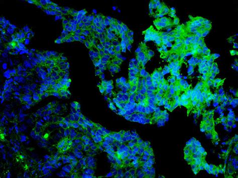 Targeting the Tumor Microenvironment to Treat Ovarian Cancer - NCI