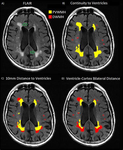 Periventricular White Matter Disease Differential Diagnosis - Pregnant Health Tips