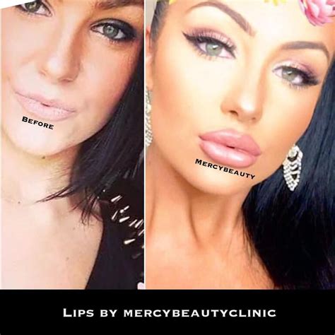Repost with full face! 😱@sarahsherriff Before and after😍 Beautiful and favourite patient Sarah's ...