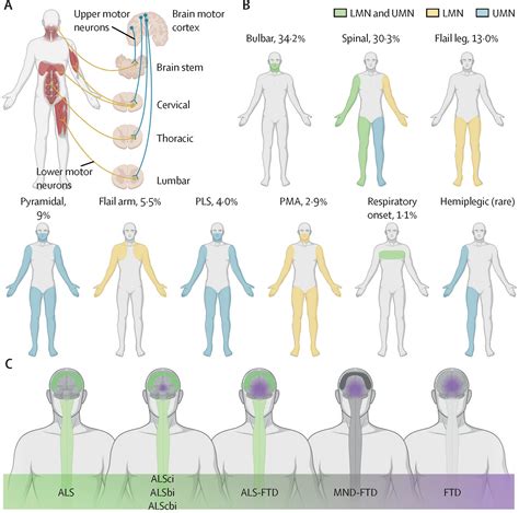Amyotrophic lateral sclerosis - The Lancet