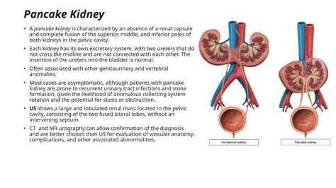 Congenital Anomalies of the Urinary tract | PPTX