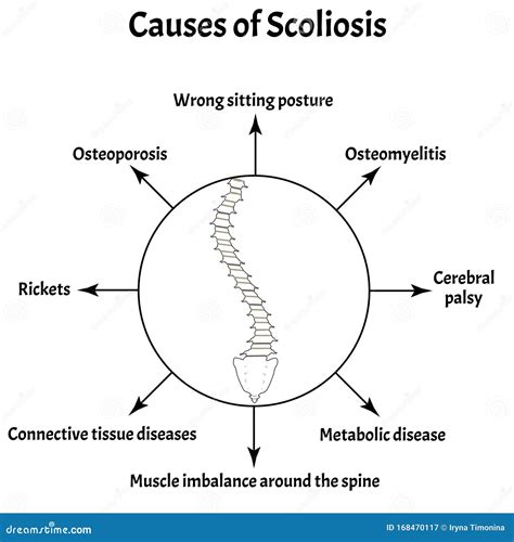 Causes Of Kyphosis. Spinal Curvature, Kyphosis, Lordosis, Scoliosis, Arthrosis. Poor Posture And ...