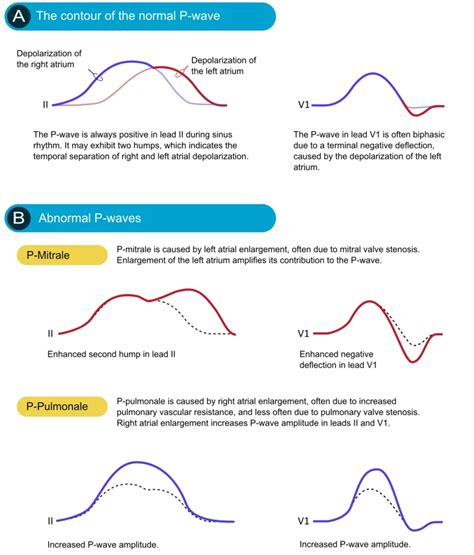 Image result for Normal vs Abnormal ECG