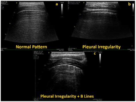 Lung Ultrasound Findings in Healthy Children and in Those Who Had ...