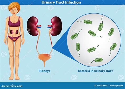 Human Anatomy of Urinary Tract Infection Stock Vector - Illustration of science, medical: 118549320