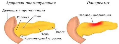Терапия панкреатита – Лечение хронического панкреатита: 5 способов ...