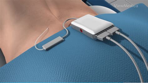 Spinal Cord Stimulator Trial