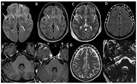 Neuroimaging of the Most Common Meningitis and Encephalitis of Adults ...