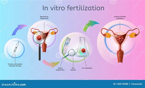 Image result for Vitro Fertilization IVF Process