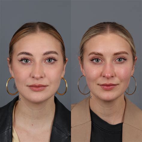 Buccal Fat Removal Before & After Photos | The Vila Institute for Plastic Surgery