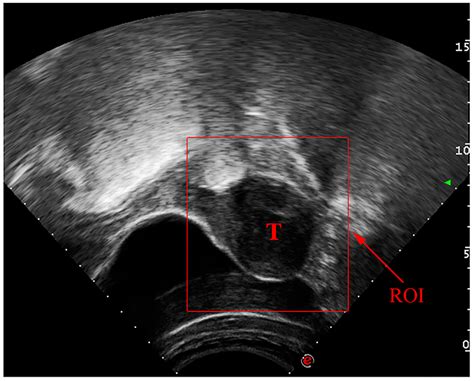 Automated Uterine Fibroids Detection in Ultrasound Images Using Deep Convolutional Neural Networks