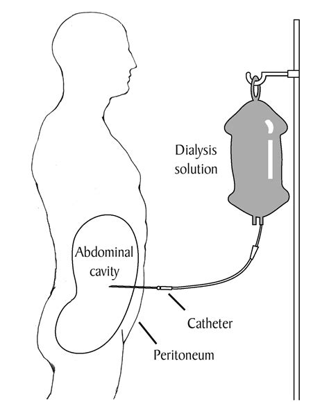 A Patients Peritoneal Dialysis Catheter Download Scientific Diagram