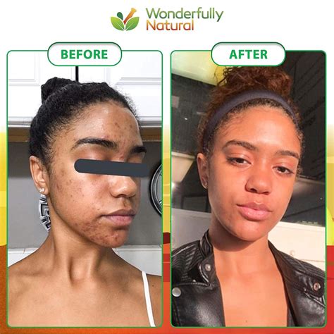 African Soap For Acne