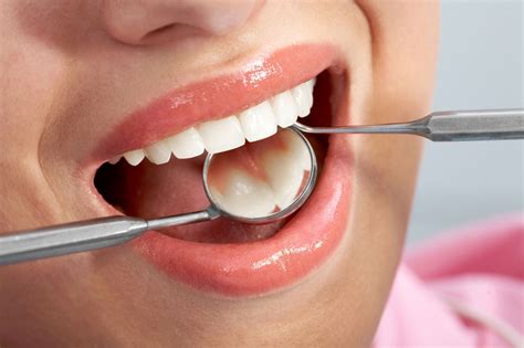 Dental Filling Procedure Steps - Fisher Pointe Dental