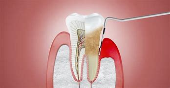 periodontal 的图像结果
