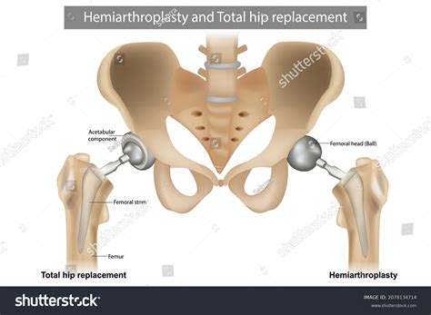 Components Of Hip Replacement
