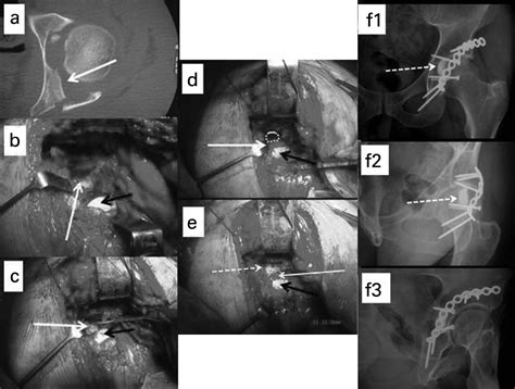 Acetabular fractures with marginal impaction | Bone & Joint