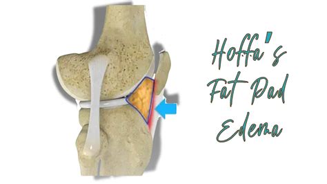 What is Hoffa's fat pad edema? - ANF Academy