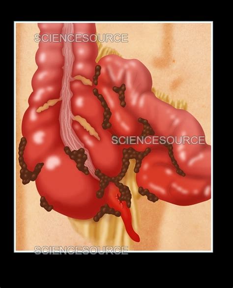Image result for Appendix Exploded