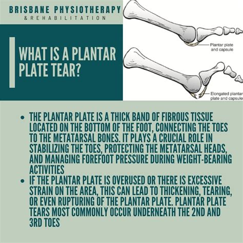 Plantar Plate Tear: Symptoms and Treatment | Brisbane Physiotherapy ...