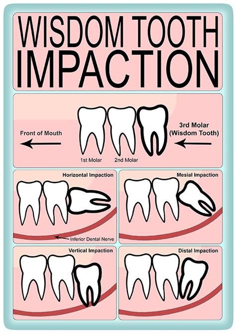 Image result for Wisdom Teeth Impaction Types