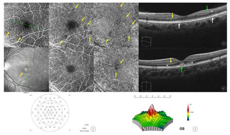 Acute Macular Neuroretinopathy after SARS-CoV-2 Infection: An Analysis ...
