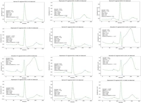 Interpretable Assessment of ST-Segment Deviation in ECG Time Series