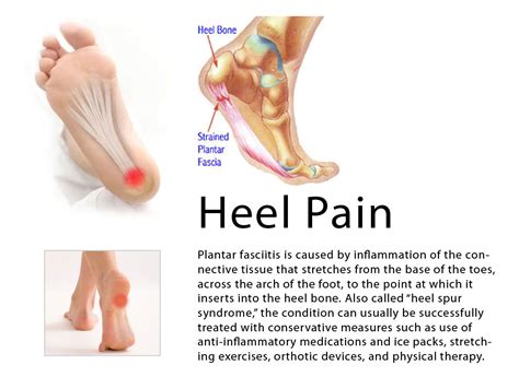 Calcaneal spur Heel pain Homeopathic Treatment