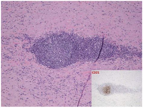 Morphea Profunda with Tertiary Lymphoid Follicles: Description of Two ...