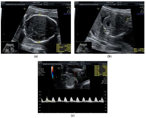 Single Fetal Demise in Twin Pregnancy—A Great Concern but Still a Favorable Outcome
