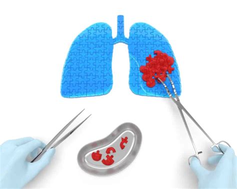 न्यूमोनेक्टॉमी (Pneumonectomy) के बारे में जानें विस्तार से - हैलो ...