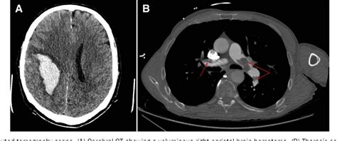 What is a pulmonary embolism, the condition that led to Catherine O’Hara’s death? | CNN