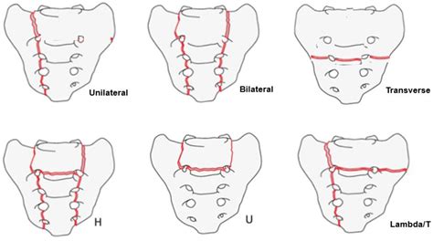 Sacral Insufficiency Fracture