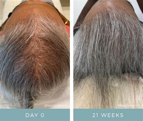 Before + After - Hair Loss 15 - NeoGenesis
