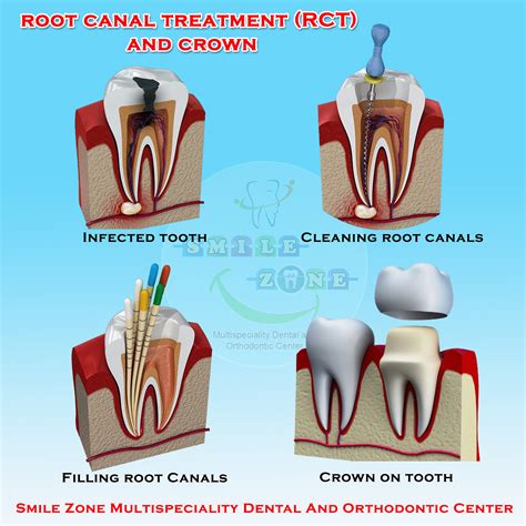 Rct Of Teeth