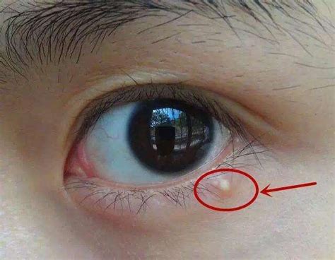 眼睛周围的小粒粒，真是眼霜惹的祸？最好的消除方法是……_皮肤