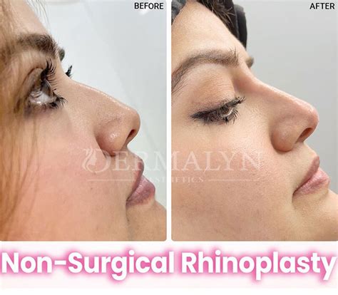 Non-surgical Rhinoplasty - Dermalyn Aesthetics