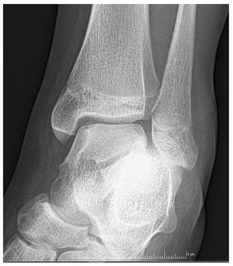Juvenile Osteochondritis Dissecans: A Case Report