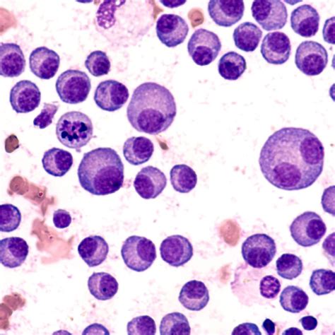 Finale OS-Daten zu Kombination mit Pomalidomid + Daratumumab ...