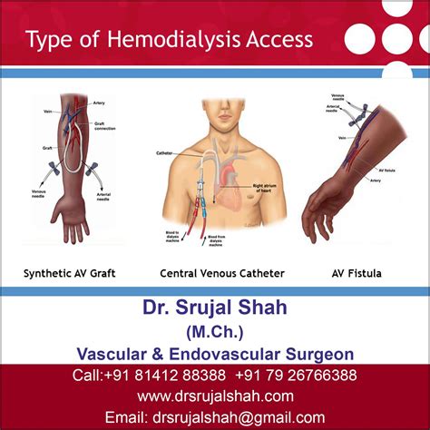 Types Of Fistula