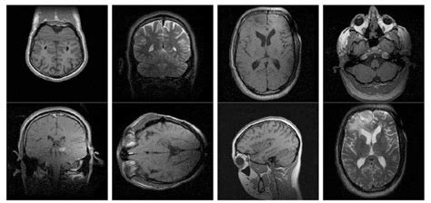 A Modified LBP Operator-Based Optimized Fuzzy Art Map Medical Image ...