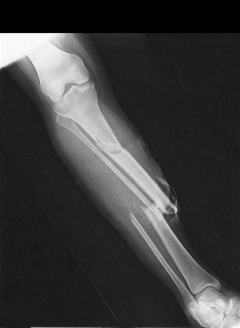 Image result for Open Fracture Surgery